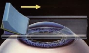 夜間の瞳孔の開き具合を踏まえた矯正範囲の設計