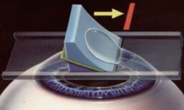 Eye surface examination for an athlete before laser vision correction