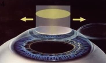 Illustration of a thin lens positioned over an eye
