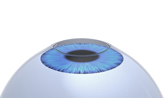 ヒーリング眼科でのICL手術の様子